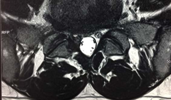 Figure 2 MRI Report Figure 2 a May 2015 Figure 2 b May 2015 May 2015 Repeat lumbar MRI taken May 14, 2015, shows marked reduction in the L5 S1 disc fragment