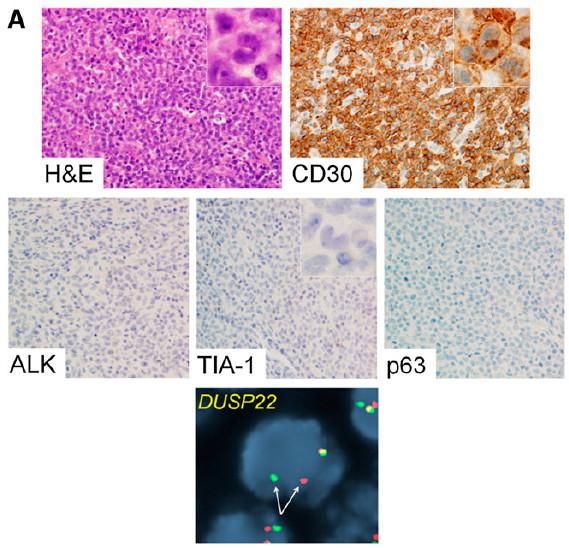 Cytotoxic Markers in DUSP22-Rearranged ALCL