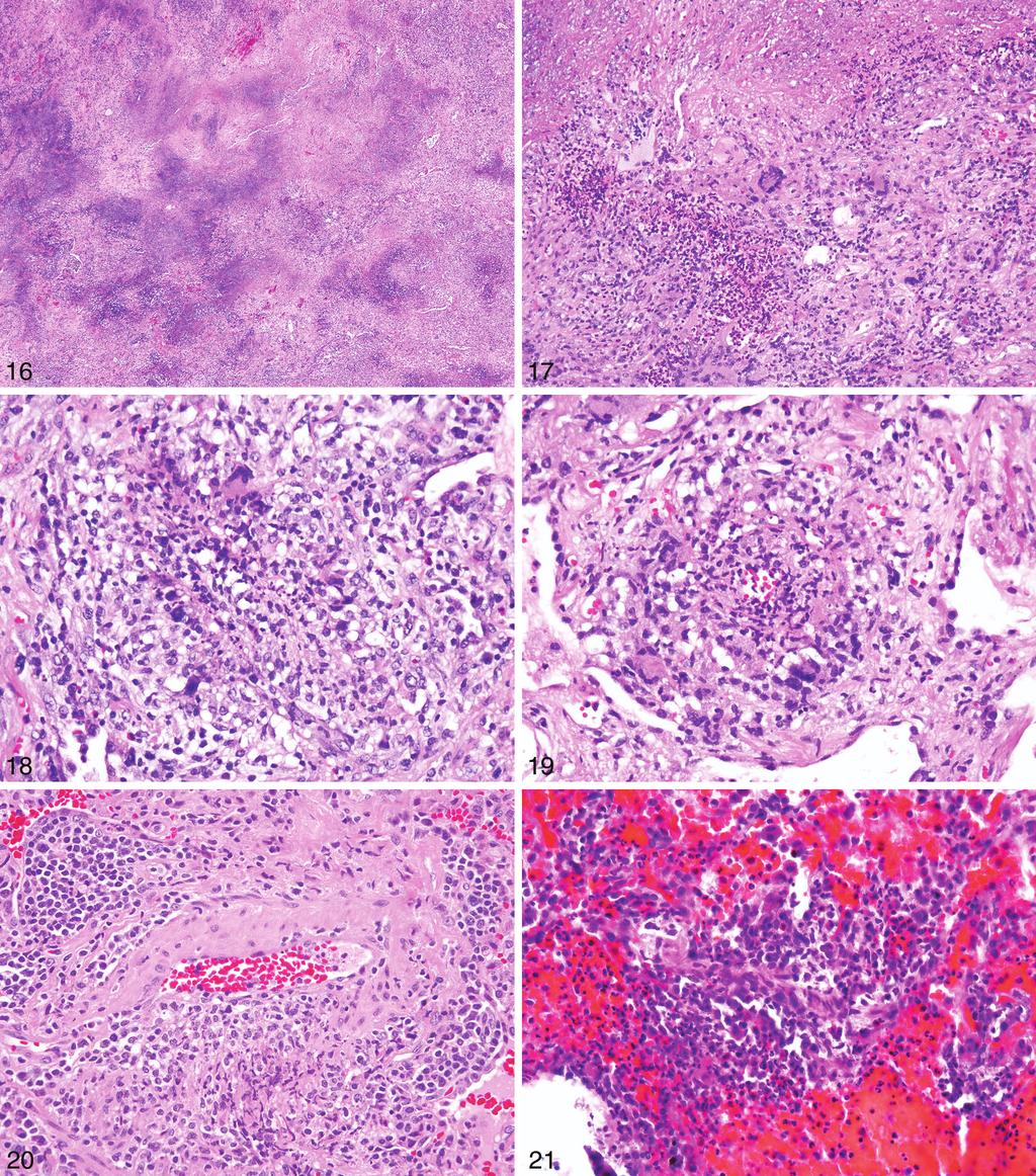 Figure 16. Low-magnification photomicrograph (case 4) showing necrotizing granulomatous inflammation in Wegner granulomatosis.