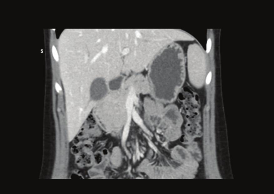 whileitappearedalmostisodensecomparedtotherestof the pancreas in the portal venous phase. Both pancreatic duct and common bile duct were prominent, with their diameter to upper normal limit.