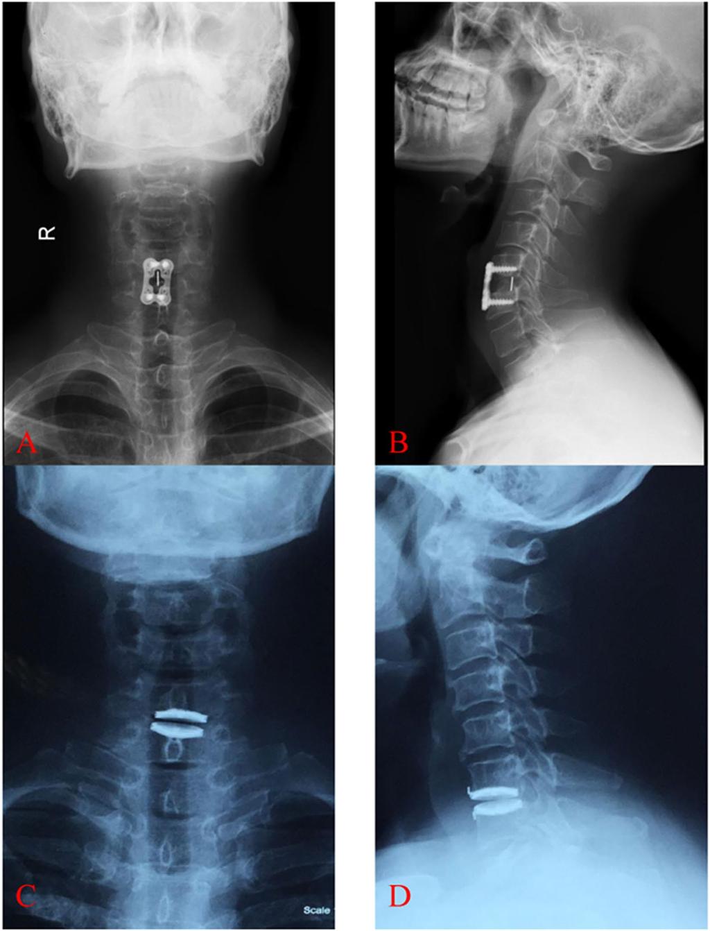 Figure 1. X-ray images of ACDF and TDR surgery in treating cervical degenerative diseases.