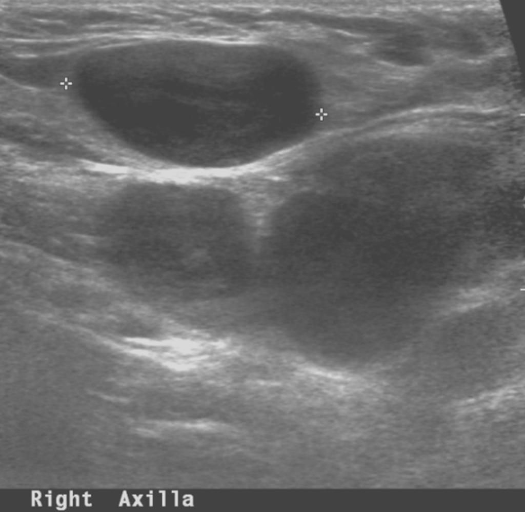 Fig. 6: Case 4. A 15-year-old woman with palpable mass in right axilla.