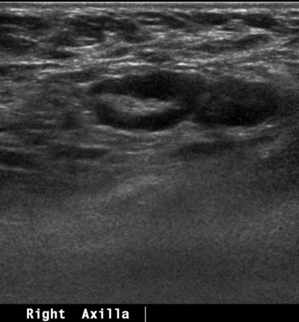 Fig. 8: Case 5. A 36-year-old woman with palpable mass in UOQ of right breast. Breast US showed indistinct irregular shaped hypoechoic mass in her entire breast.