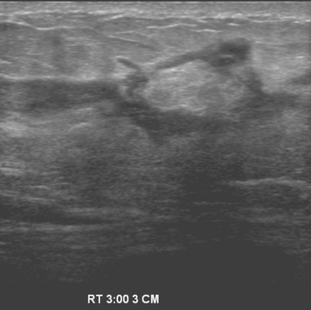 Fig. 9: Case 6. A 34-year-old woman with multiple masses in right breast. Breast US showed multiple hypoechoic masses with tubular extention connecting masses in her right breast inner quadrant.