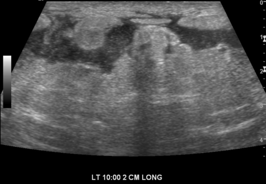 Fig. 10: Case 7. A 24-year-old woman with multiple masses in right breast. Breast US showed multiple hypoechoic masses with tubular extention connecting masses in her right breast inner quadrant.
