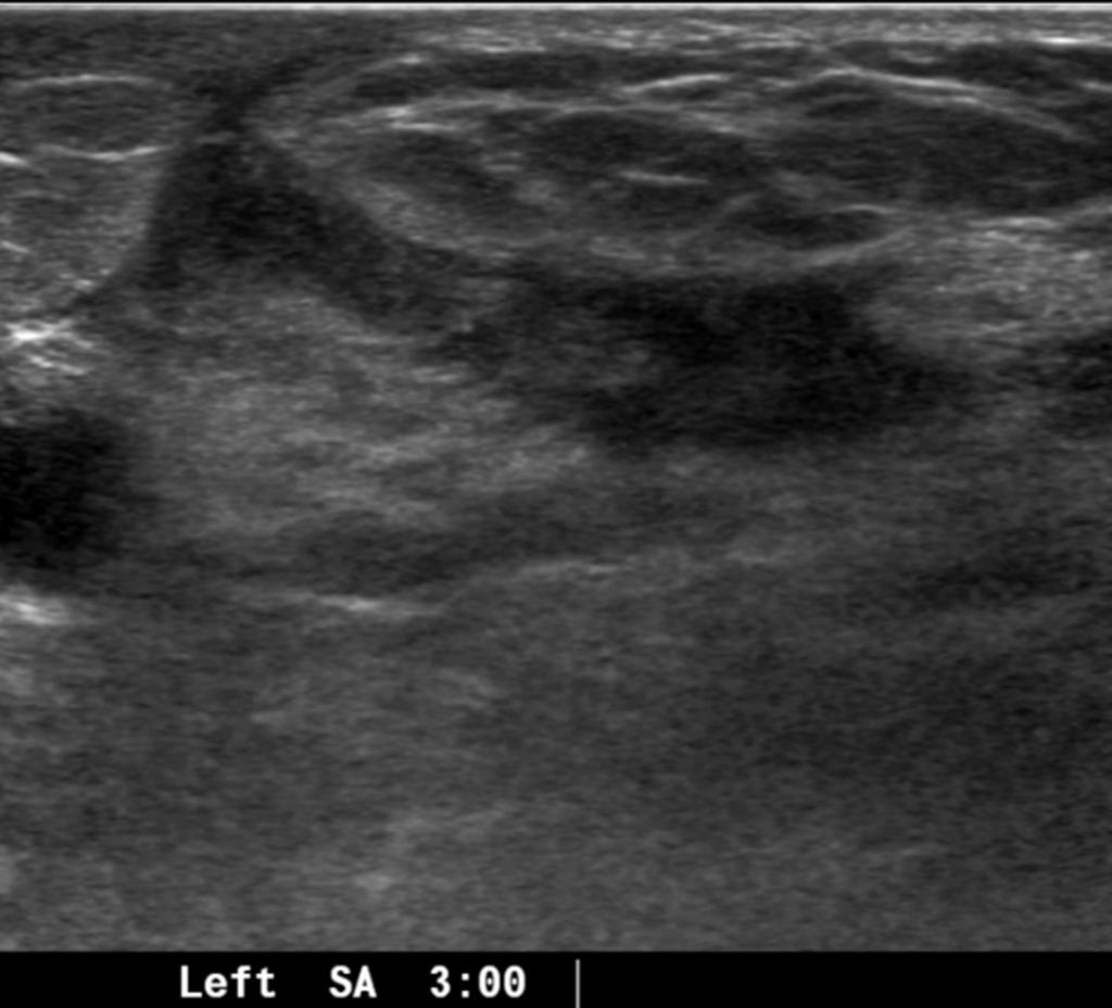 Fig. 11: Case 8. A 36-year-old woman with previous history of inflammation in left breast.