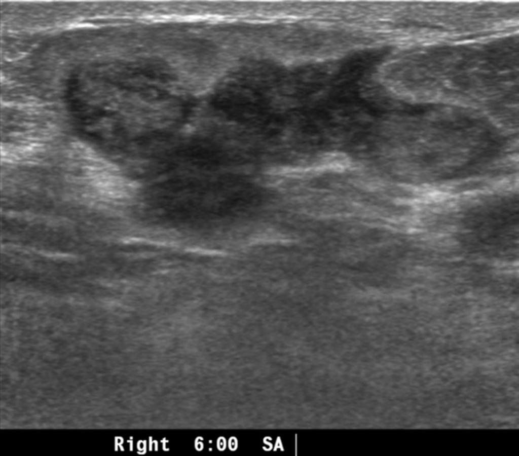 Fig. 2: Case 2. A 59-year-old woman with palpable mass in right breast.