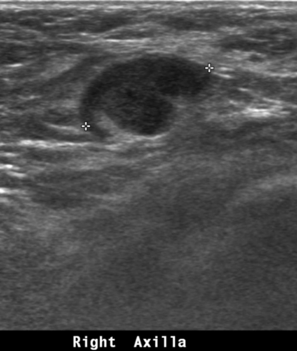 Fig. 3: Case 2. A 59-year-old woman with palpable mass in right breast. Right axillary LN enlargement was also seen.