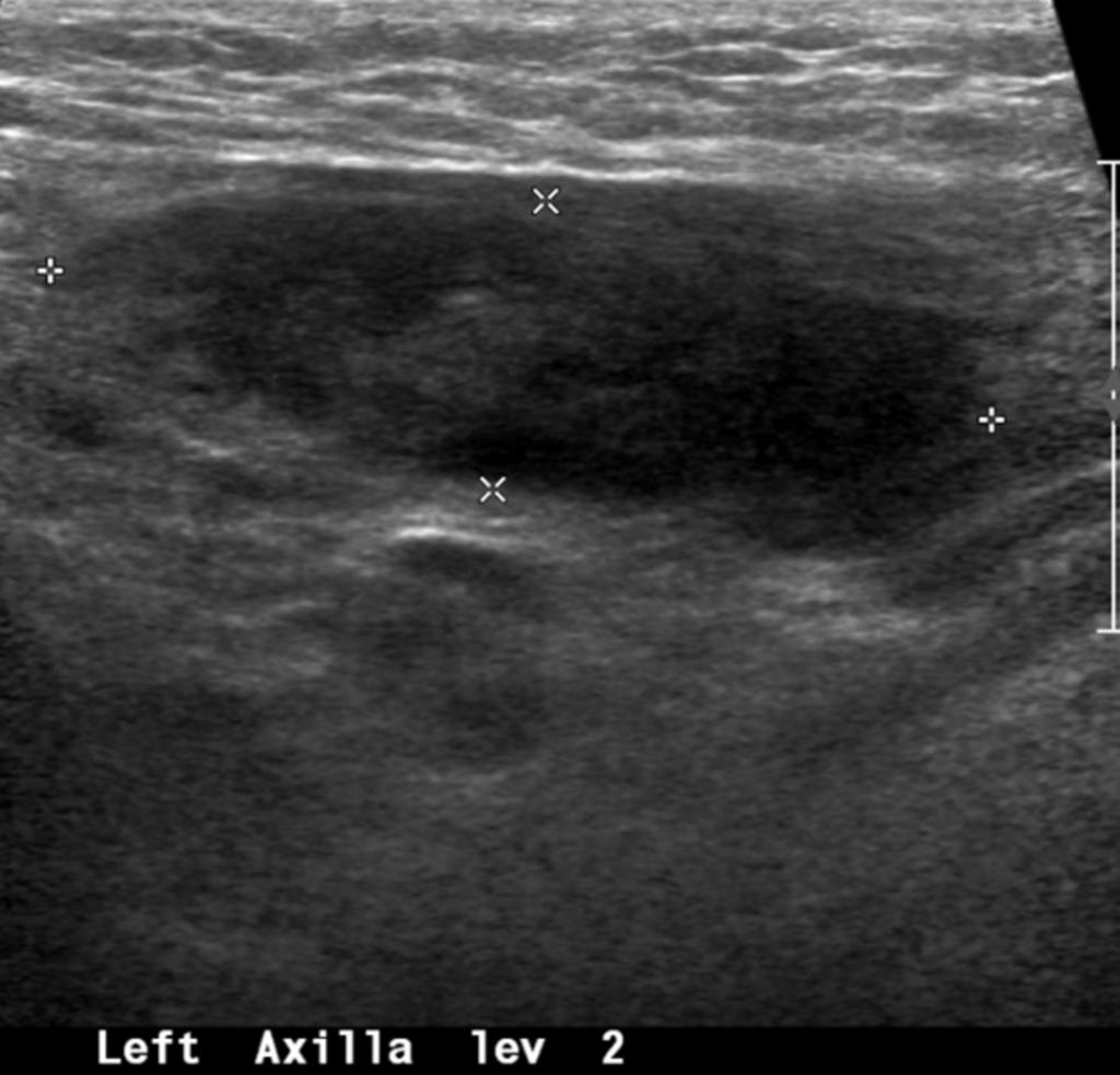 Fig. 5: Case 3. A 27-year-old woman with swelling and heating sensation in left axilla Necrotic lymph nodes w.ere also seen at left axilla level II.