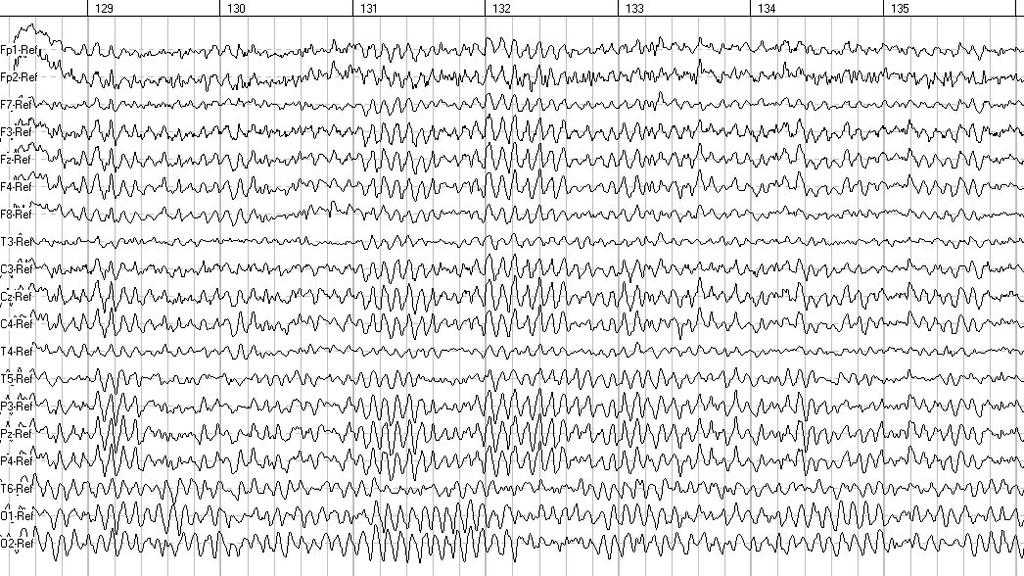 Synchronous Brain Waves of a