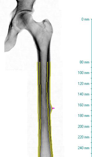 Atypical femur fracture measurement and analysis provides an X-ray image of the entire femur for both qualitative visual assessment and quantitative measures to identify areas of focal thickening