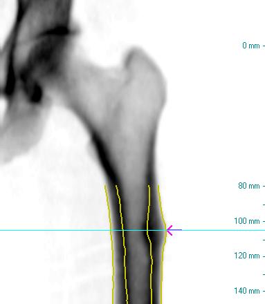 Figure 5: Medial Cortical Width Profile along the femoral shaft of the medial cortical width in mm.