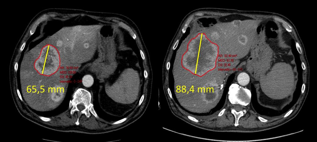 242 Comparison of Radiological Criteria (RECIST - MASS - SACT -Choi) in Antiangiogenic Therapy of Renal Cell Carcinoma Figure 2. Example of Progressive Disease.