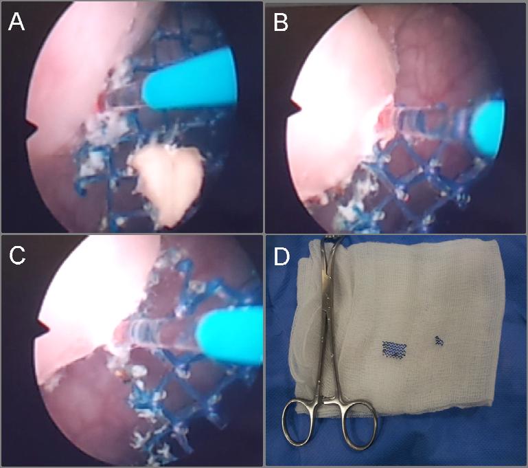 Figure 1: Intraoperative images demonstrating surgical technique for endoscopic laser excision of eroded TVT.