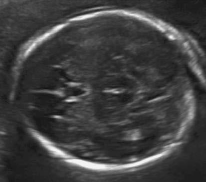 The new england journal of medicine Fetal ultrasonography that was performed at 3, 6, and 7 weeks of gestation (, 4, and 5 weeks after the resolution of symptoms) showed no evidence of microcephaly