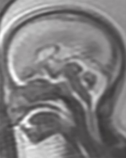 On T 2 -weighted imaging of the brain of the ZIKV-exposed fetus, a 3-mm-thick axial view (Panel A)