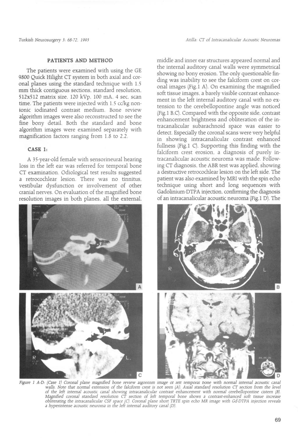 Atilla: CT of 1ntracanaJicuJarAcoustic Neurornas CASE 1: PATIENTS AND METHOD The patients were examined with using the GE 9800 Quick Hilight CT system in both axial and coronal planes using the