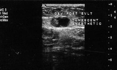 EVLT: Tumescent EVLT: Post Procedure Ultrasound Tumescent: