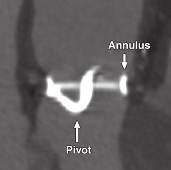 nnulus diameter (D) and geometric orifice area (GO) are measured from short-axis image as shown.