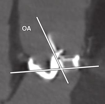 or discs during both disc closure (D) and opening (E). For single-disc valves, image incorporates center pivot arm.