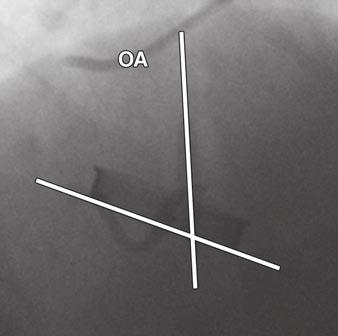 G, Transthoracic echocardiography image shows inability to directly visualize valve (arrow) due to artifact. conversion factor for abdominal CT [0.