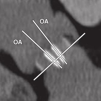 cursor centered on short-axis valve orifice., CT image shows bileaflet discs closed with complete apposition., Opening angle (O) of each disc is measured in comparison with annulus as baseline.