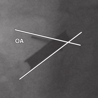 and, This case represents disagreement in opening angle (O) between CT () and cinefluoroscopy (). With CT, opening angle was 76.
