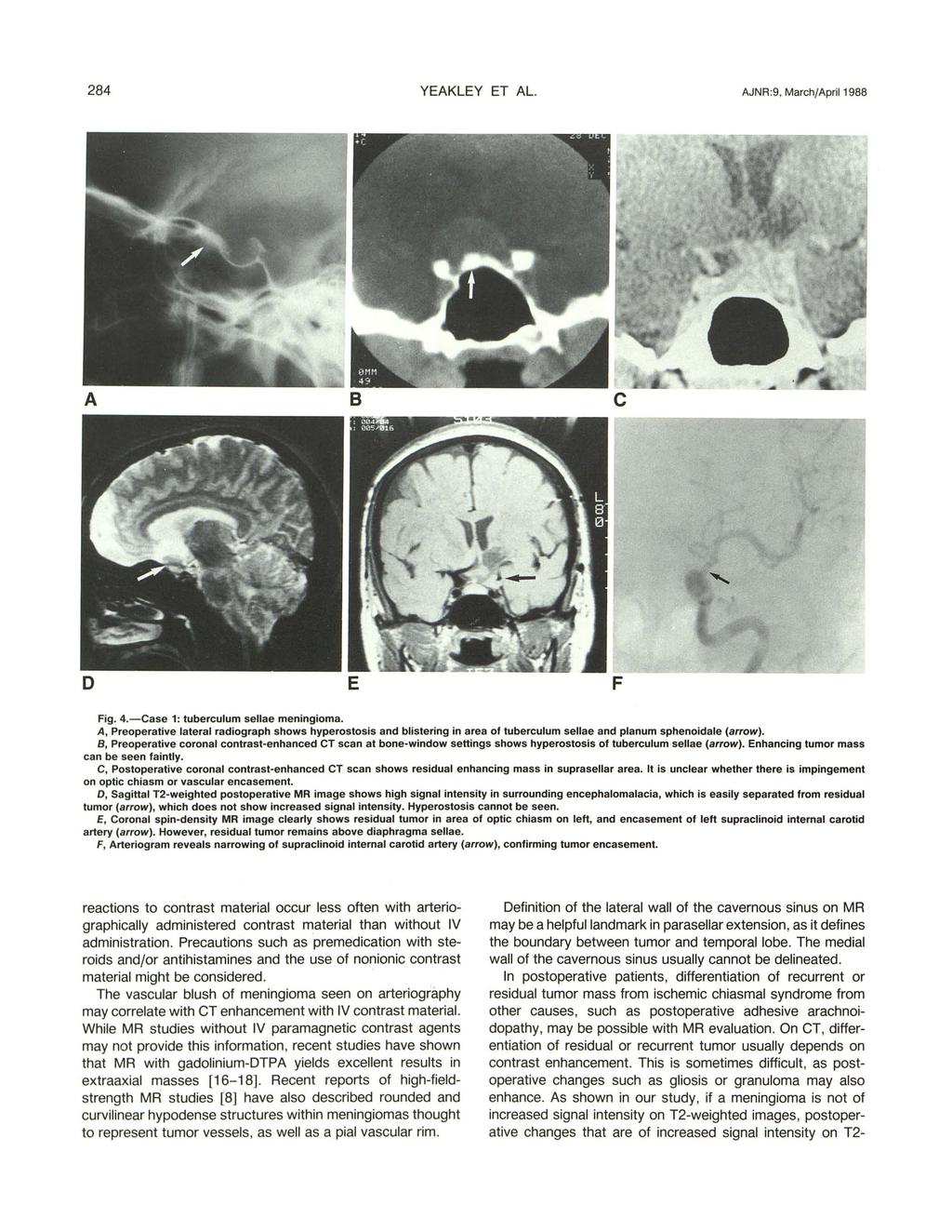 284 YEAKLEY ET AL. AJNR:9, March/April 1988 Fig. 4.-Case 1: tuberculum sellae meningioma.