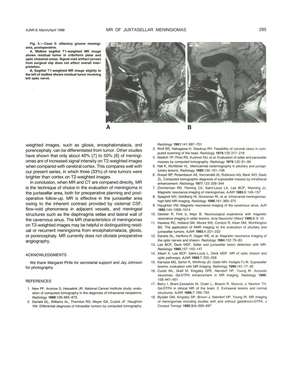 AJNR:9, March/April 1988 MR OF JUXTASELLAR MENINGIOMAS 285 Fig. 5.-Case 5: olfactory groove meningioma, postoperative.