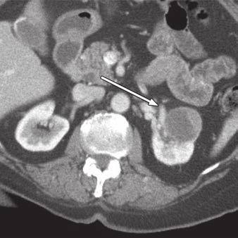 A C, Lesion (arrow) is well-circumscribed and homogeneous, with maximum attenuation value measurements of 137, 97,