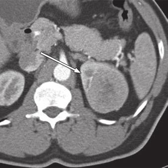 3 79-year-old woman with 4-cm cystic chromophobe renal cell carcinoma discovered after she presented with left