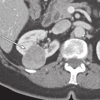 A and B, Venous (A) and delayed (B) images show predominantly cystic mass (arrow) in left kidney with mural soft