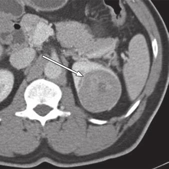 left kidney with well-defined central scar and necrosis.