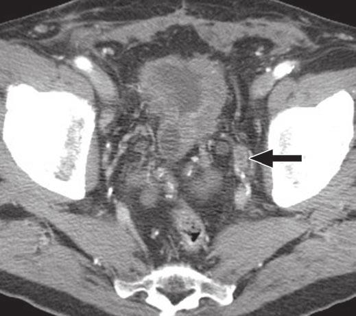 PET/CT of Transitional Cell Carcinoma Downloaded from www.ajronline.org by 37.44.193.45 on 01/04/18 from IP address 37.44.193.45. Copyright RRS.