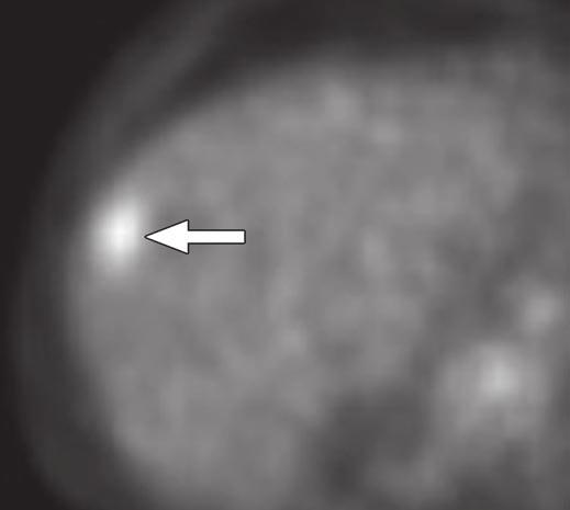 , xial unenhanced CT image from staging PET/CT study shows subtle nonspecific hypodense focus (arrow) in liver.