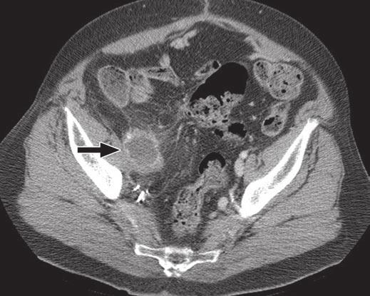 PET/CT of Transitional Cell Carcinoma Downloaded from www.ajronline.org by 37.44.193.45 on 01/04/18 from IP address 37.44.193.45. Copyright RRS. For personal use only; all rights reserved Fig.