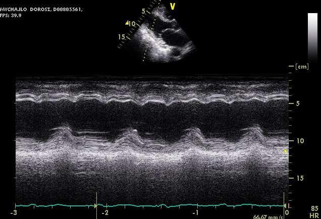 dilated RV and paradoxical septal motion
