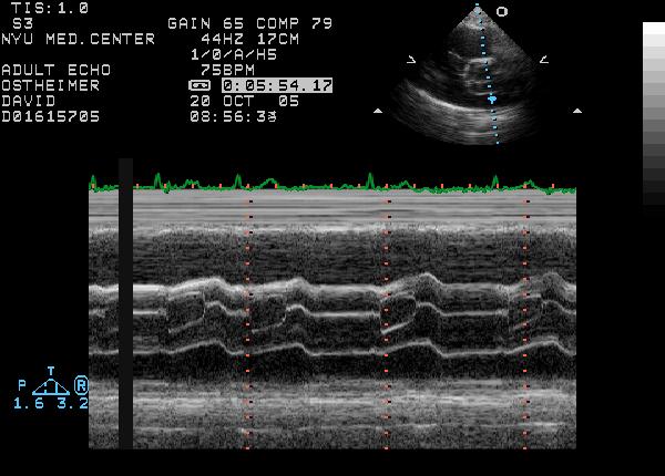 This M mode finding is not associated with increased risk of A. Coarctation B. Pulmonic Stenosis C. Subaortic Stenosis D.