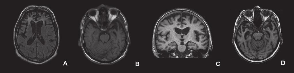 Color Figures Chapter 1.2 Figure 1 Imaging of FTD subtypes (A) Frontal atrophy on axial fluid attenuated inversion recovery MRI of a patient with behavioural variant of FTD (bvftd).