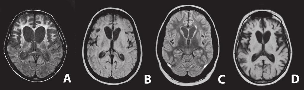Color Figures Chapter 4.2 Figure 1 MRI scans of FTLD-FUS cases (A) Patient 1 with severe atrophy (PD-weighted MR image). (B) Patient 2 with severe atrophy (PD-weighted MR image).