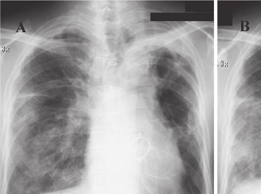 Figure 1. A: Chest radiograph on admission shows diffuse bilateral ground-glass opacity, particularly in the right lung field.