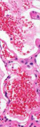 D: Photomicrograph of pathology shows an area of lung parenchyma with the alveolar spaces occupied by red blood cells and the