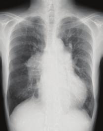 2 Case Reports in Pulmonology (c) (d) Figure 1: Chest X-ray obtained before percutaneous transluminal pulmonary angioplasty, on the first postoperative day (POD1), POD4 (c), and POD8 (d).