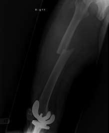 # Cheung et al # (a) (b) FIG 1. X-ray of right femur upon admission a trephine biopsy needle, under local anaesthesia.