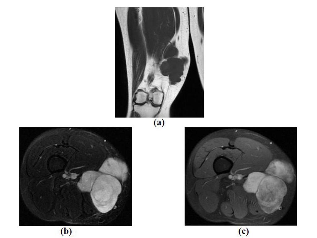 Fig. 6: Myxoid liposarcoma with prominent round cell component in a 35-year-old female who presented with a slowly enlarging, painless mass in the subcutaneous and deep tissues of the distal thigh.