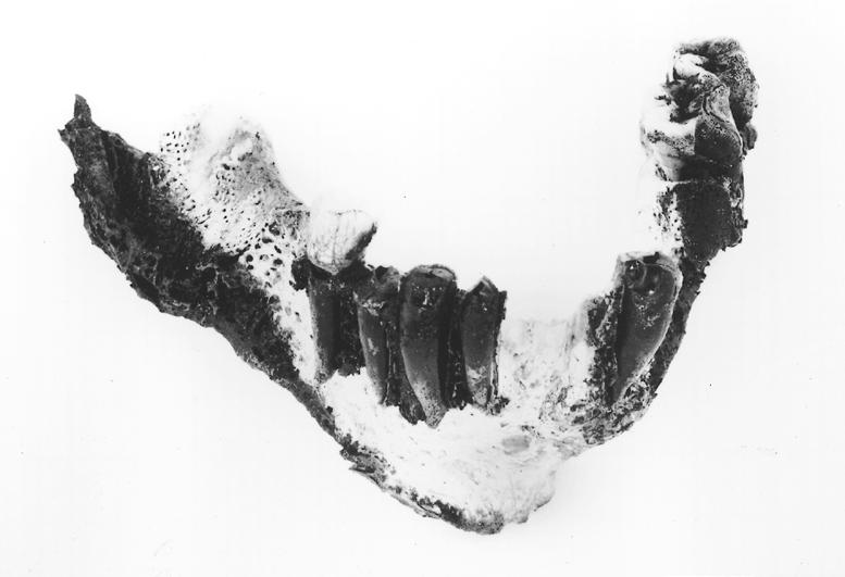 Fig. 29-1 Example of charred dental remains. The mandible (lower jaw) has the crowns of the teeth fractured off. Fig.