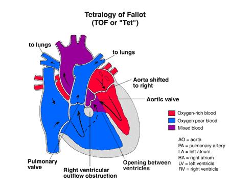 Obstructed pulmonary blood flow