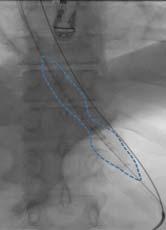Hydraulic dilation Placement over a thin-tipped guidewire EGJ 8.