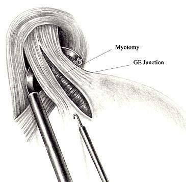 HELLER MYOTOMY - Requires 1-2 days of hospitalization - Needs to be performed by an
