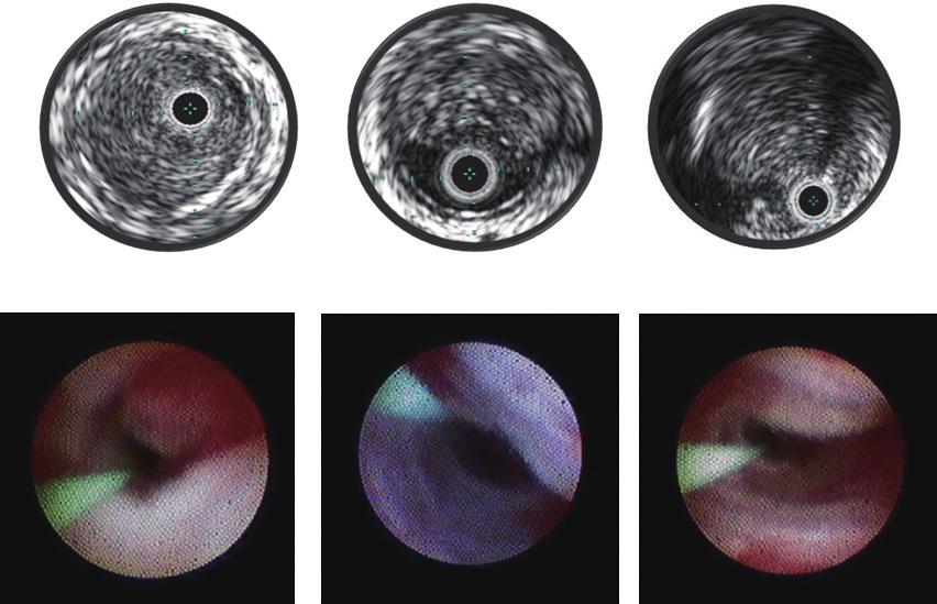 1072 A B C D E F Fig.1. Definition of wire passage according to IVUS findings. (A) Intraplaque is defined as an inside plaque. (B) Subintimal is between the plaque and media.